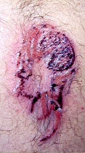 black henna injury
